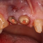 Hopeless teeth before bone graft and dental implants