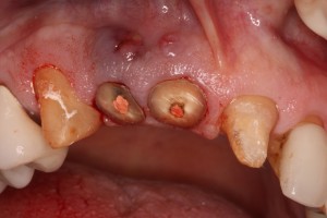 Hopeless teeth before bone graft and dental implants