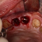 Extractions in preparation of bone graft and subsequent dental implants