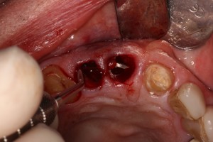 Extractions in preparation of bone graft and subsequent dental implants