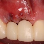 Completed Bone Graft with Temporary bridge in preparation for dental implants