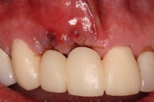 Completed Bone Graft with Temporary bridge in preparation for dental implants