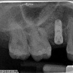 X ray of Dental Implant placed within bone graft