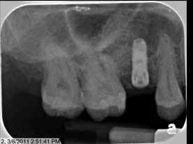 X ray of Dental Implant placed within bone graft