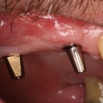 Dental Implants permit desired normal function