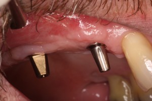 Dental Implants permit desired normal function