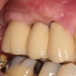 Reconstruction of missing teeth utilizing Dental Implants