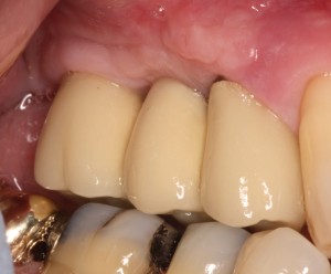 Reconstruction of missing teeth utilizing Dental Implants