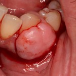 Periodontist - Gum Overgrowth