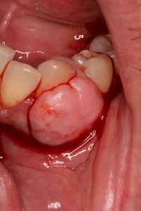 Periodontist - Gum Overgrowth