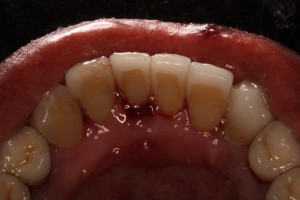 Bleeding Gums