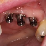 Dental Implants prior to placement of transitional bridge