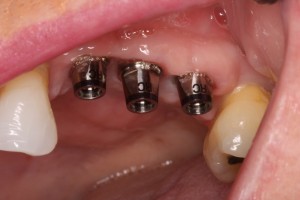 Dental Implants prior to placement of transitional bridge