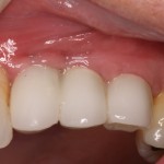 Dental Implants supporting temporary restorations