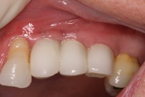 Dental Implants supporting temporary restorations