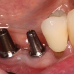 Dental implant rehabilitation prior to final impression.