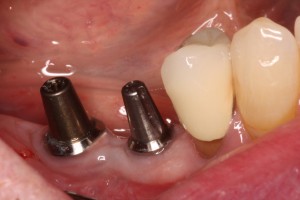 Dental implant rehabilitation prior to final impression.