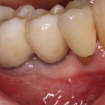 Completed Dental Implant Rehabilitation