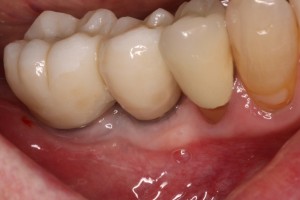 Completed Dental Implant Rehabilitation