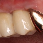 Implant Dentistry with Porcelain Zirconia Implant Restorations