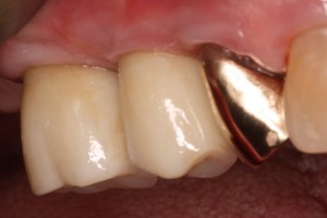 Implant Dentistry with Porcelain Zirconia Implant Restorations