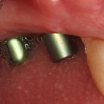 Dental Implants ready to regain function