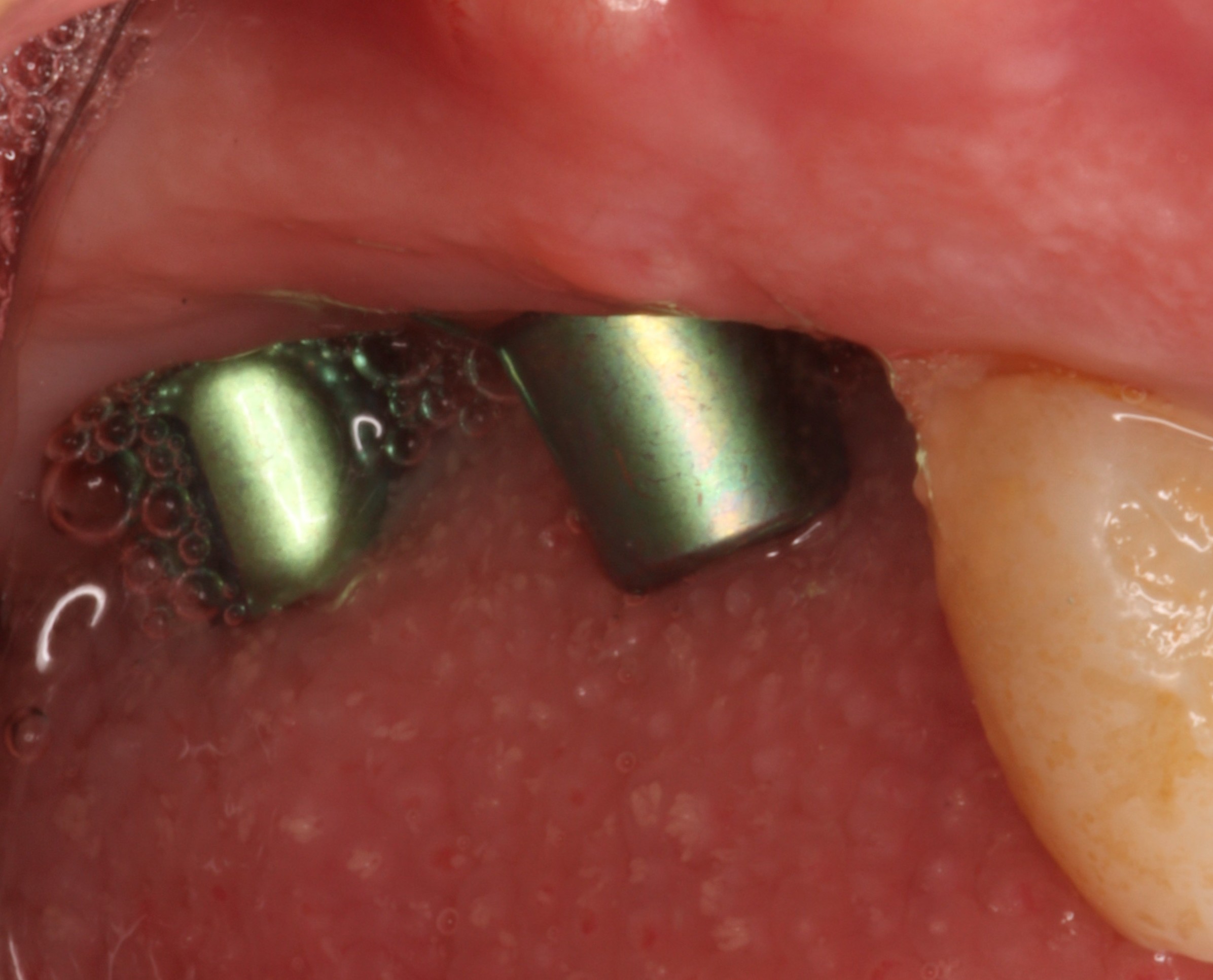Dental Implants ready to regain function