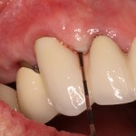 Gum Disease Treatment