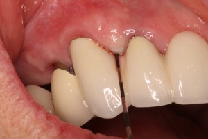 Gum Disease Treatment