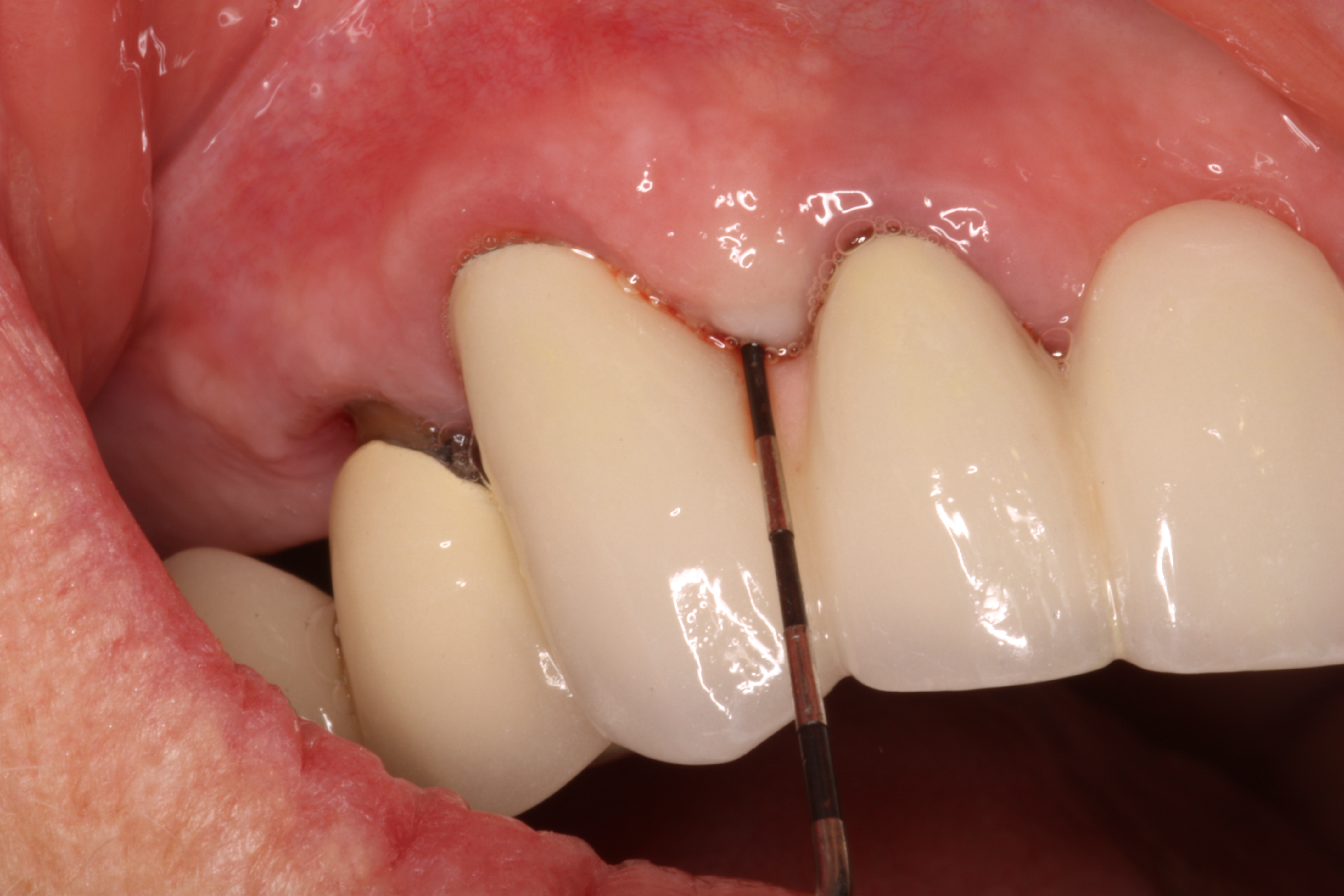 Gum Disease Treatment