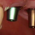 Healthy Gums & Dental Implants Before Restorative Treatment