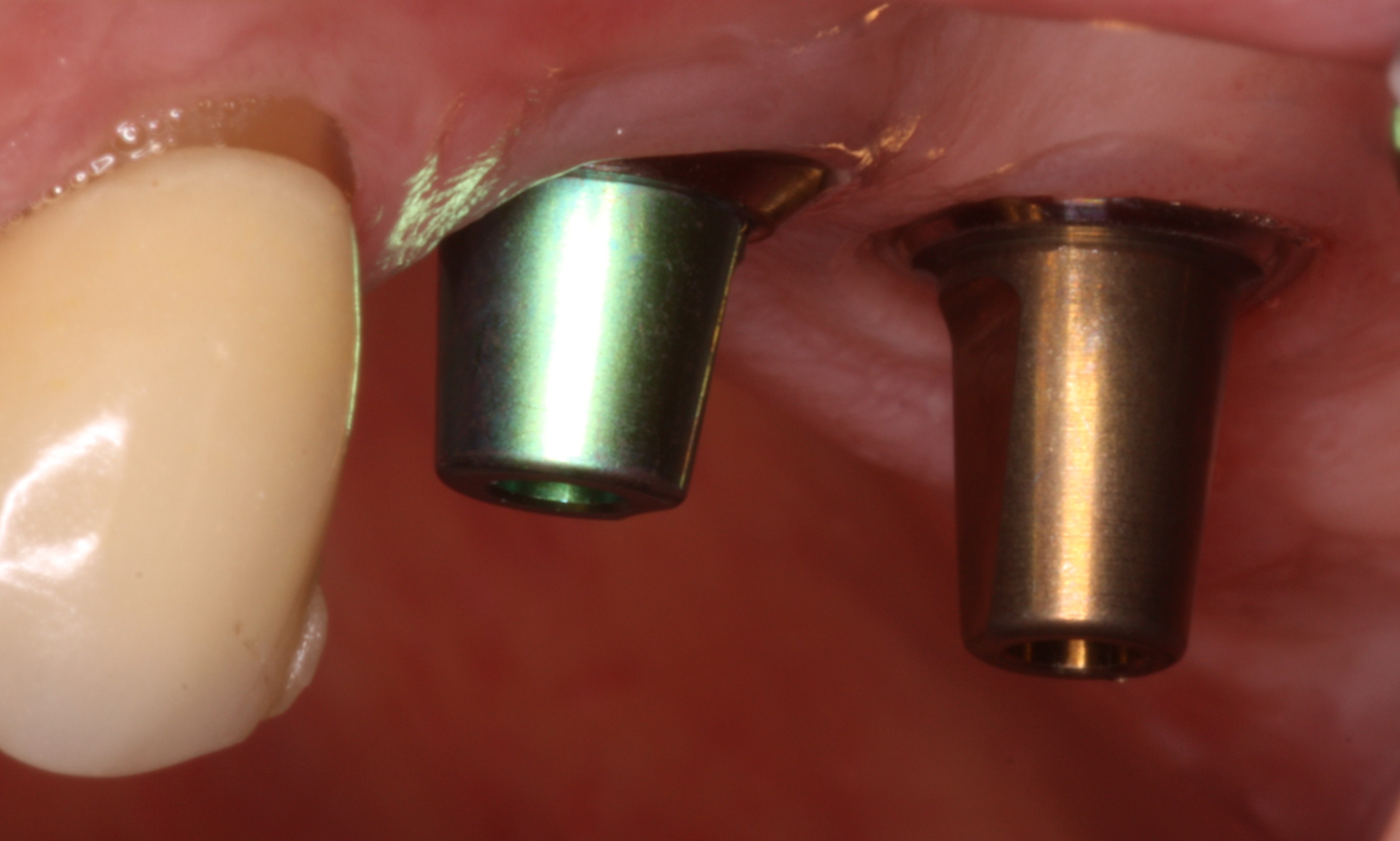 Healthy Gums & Dental Implants Before Restorative Treatment