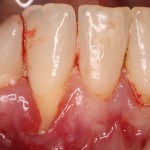 Gum Deformity with chronic inflammation