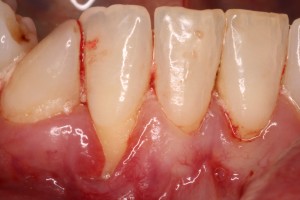 Gum Deformity with chronic inflammation