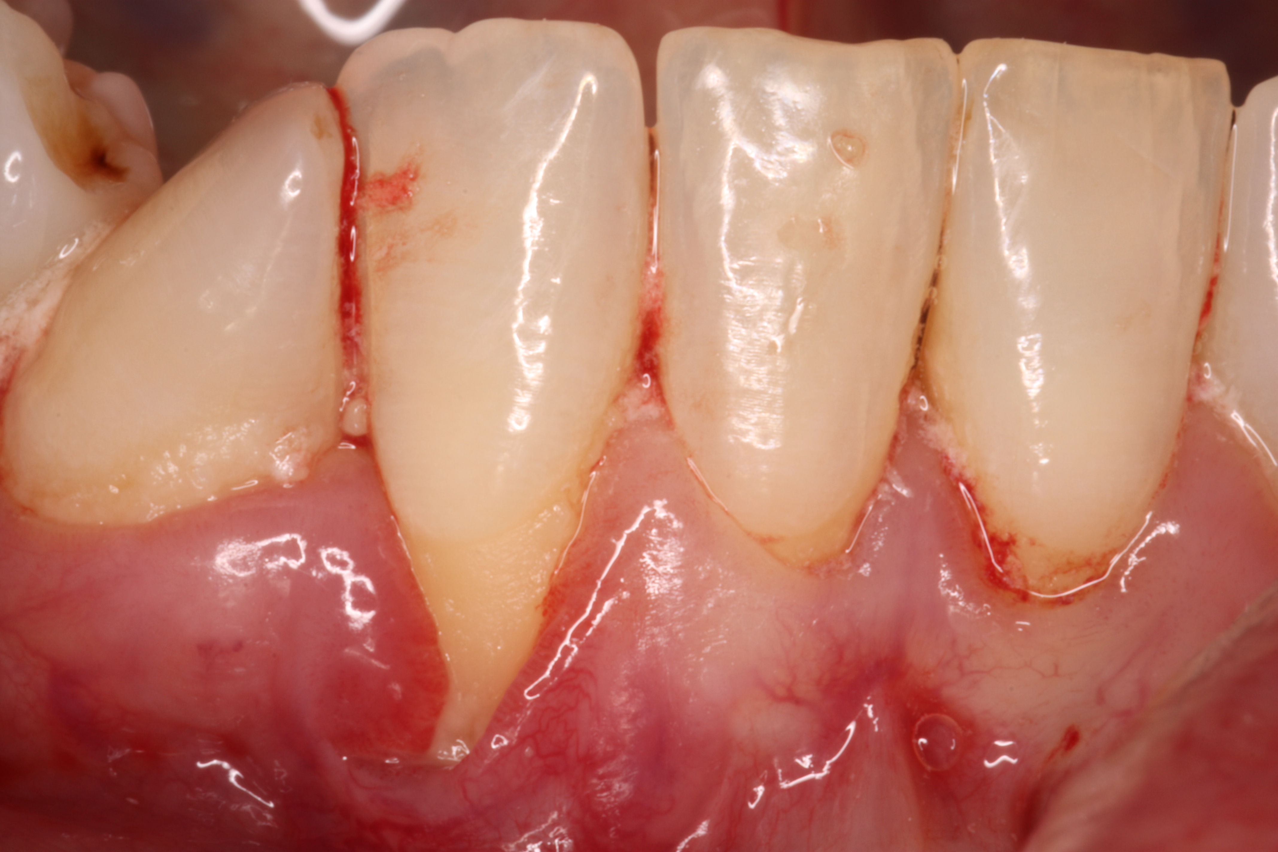 Gum Deformity with chronic inflammation