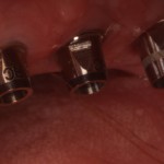 Unrestored bone level dental implants with abutments placed.