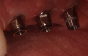 Unrestored bone level dental implants with abutments placed.
