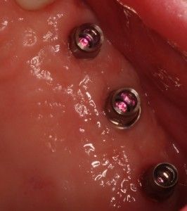 Top view of unrestored dental implants with abutments torqued.