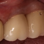 Restored Dental Implants with Healthy Gums