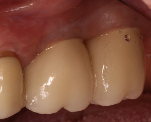 Restored Dental Implants with Healthy Gums