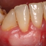Resolution of Gum Deformity and chronic inflammation.