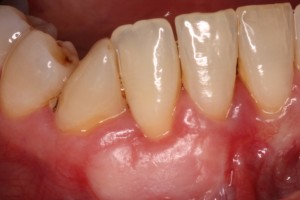 Resolution of Gum Deformity and chronic inflammation.