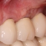 Restored Upper Left Bone Level Dental Implants