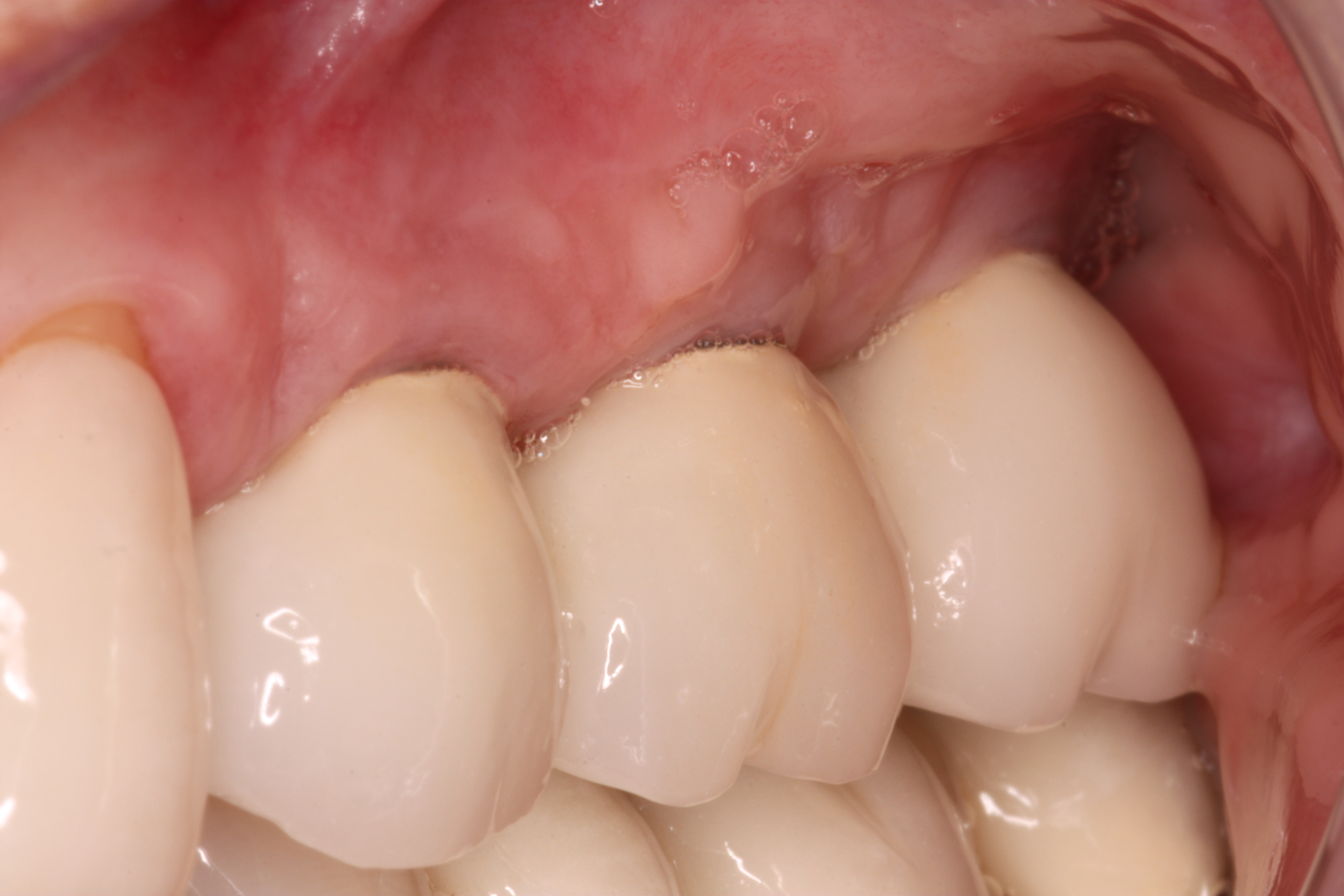 Restored Upper Left Bone Level Dental Implants
