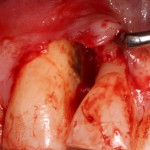 Bacterial induced chronic inflammation resulting in bone loss.