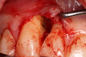 Bacterial induced chronic inflammation resulting in bone loss.