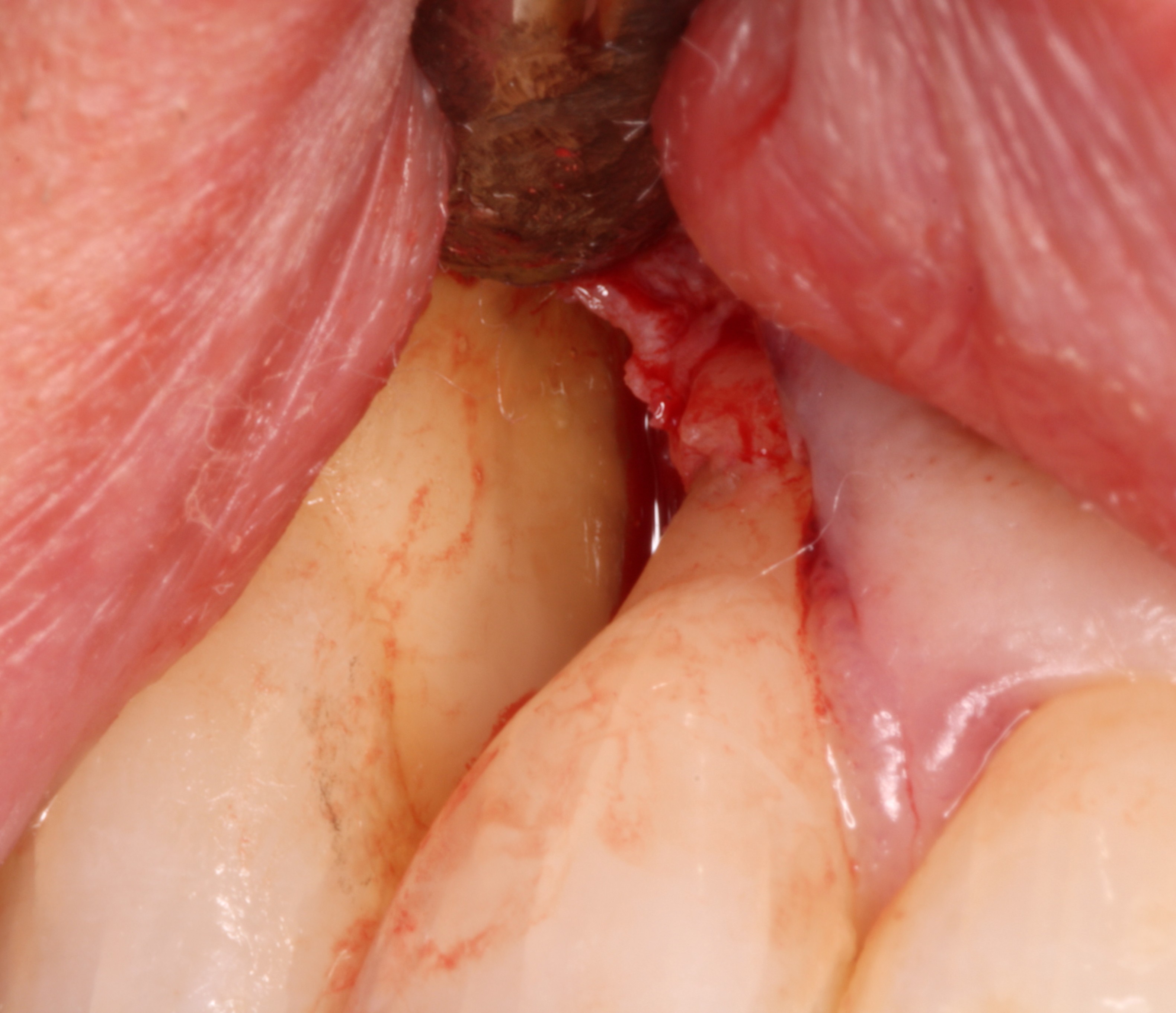 Bacterial removal and stopping future bone loss.