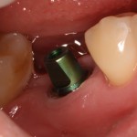 Dental implant with a solid abutment torqued to 35Ncm.