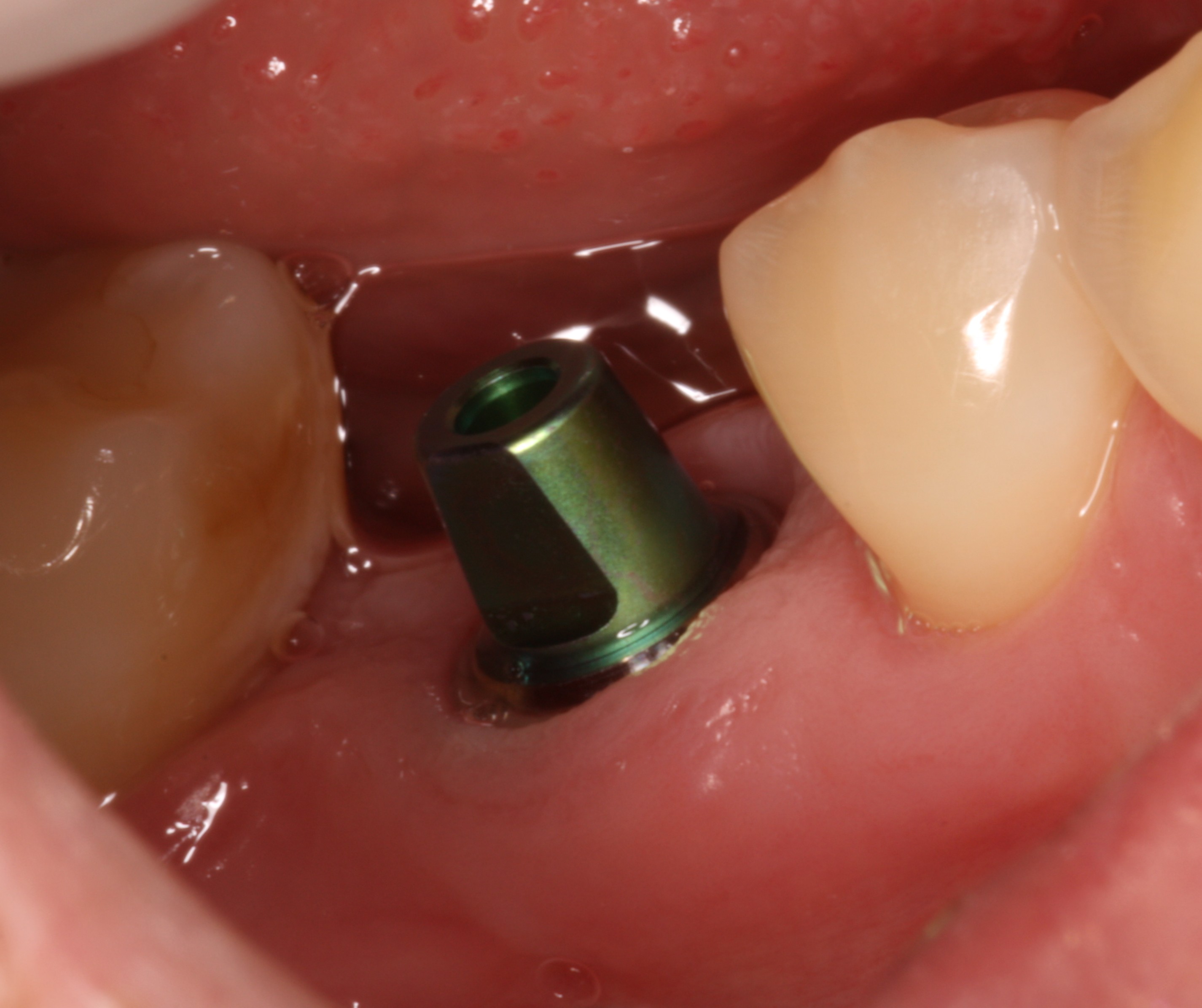 Dental implant with a solid abutment torqued to 35Ncm.