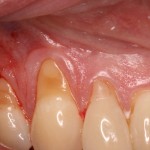 Receding Gums & Tooth Sensitivity